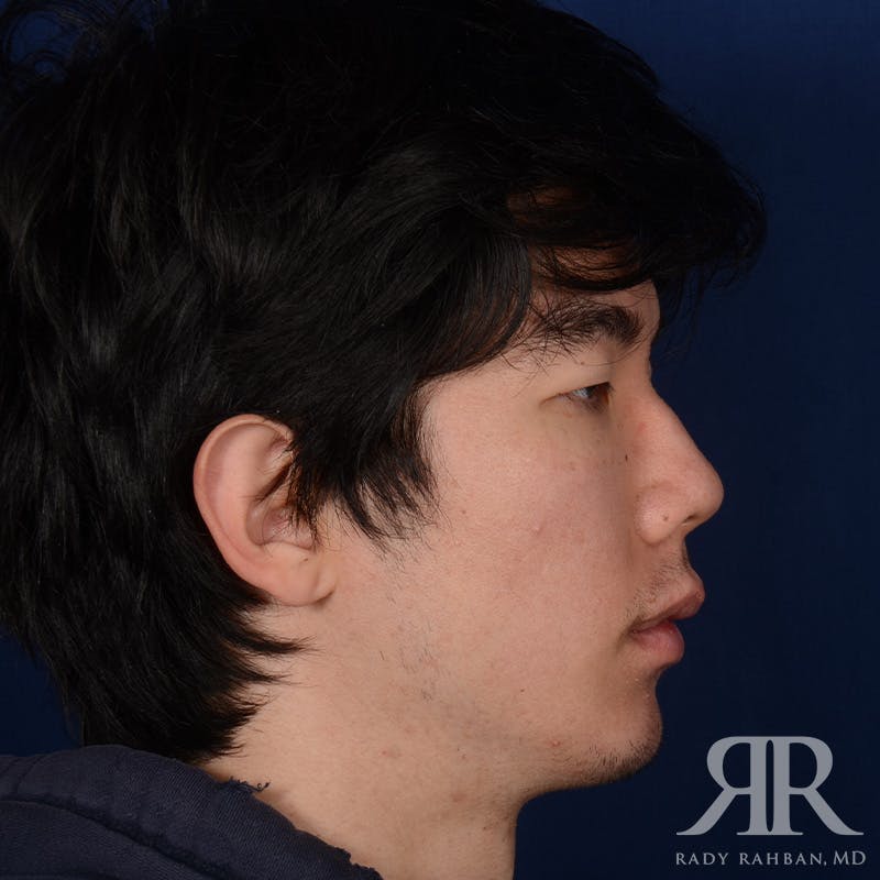 Chin Augmentation Before & After Gallery - Patient 309121 - Image 5