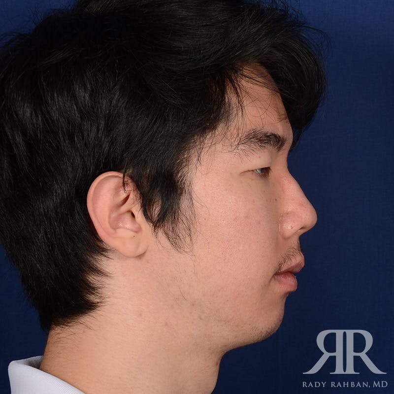 Chin Augmentation Before & After Gallery - Patient 309121 - Image 6