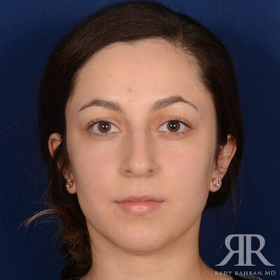 Chin Augmentation Before & After Gallery - Patient 339634 - Image 1