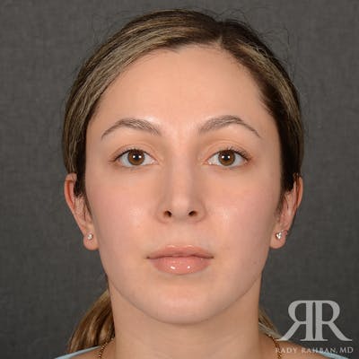 Chin Augmentation Before & After Gallery - Patient 339634 - Image 2