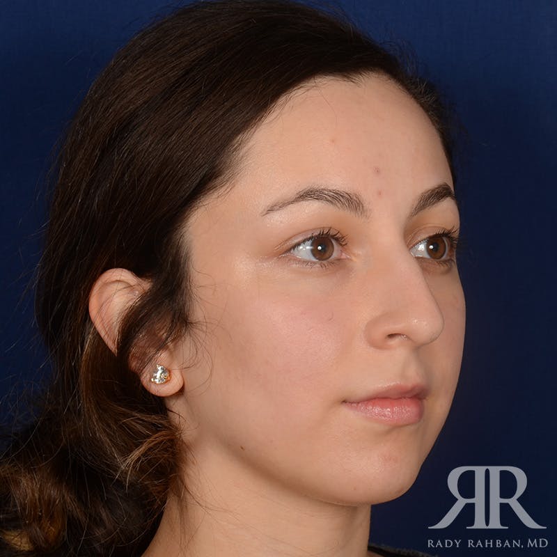Chin Augmentation Before & After Gallery - Patient 339634 - Image 3