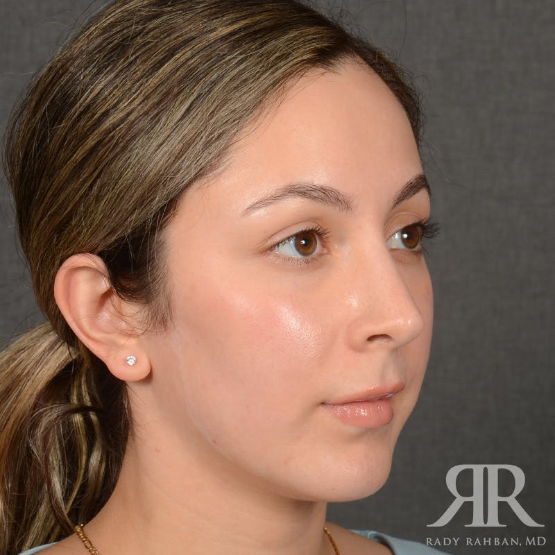 Chin Augmentation Before & After Gallery - Patient 339634 - Image 4