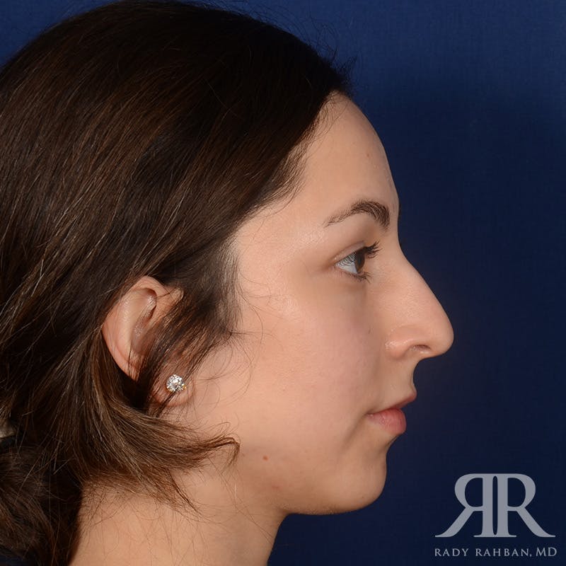 Chin Augmentation Before & After Gallery - Patient 339634 - Image 5