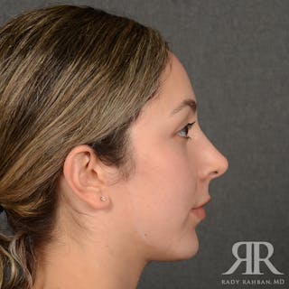 Chin Augmentation Before & After Gallery - Patient 339634 - Image 6