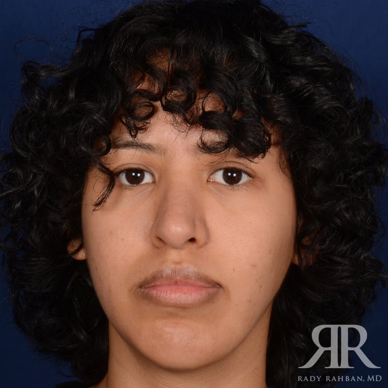 Chin Augmentation Before & After Gallery - Patient 328946 - Image 1