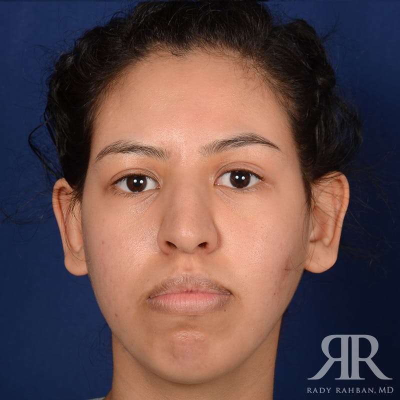 Chin Augmentation Before & After Gallery - Patient 328946 - Image 2