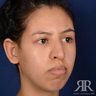 Chin Augmentation Before & After Gallery - Patient 328946 - Image 4