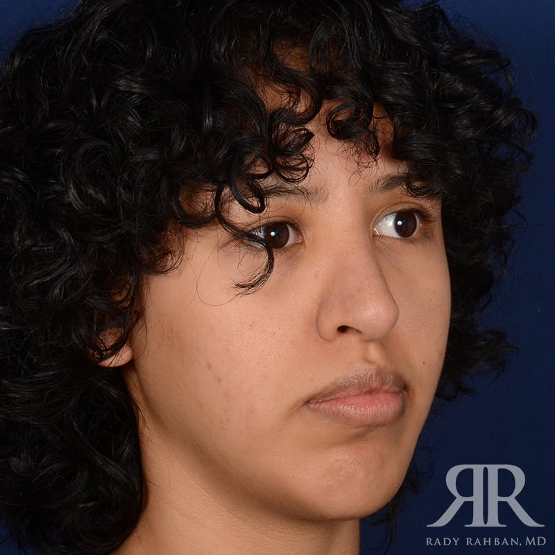 Chin Augmentation Before & After Gallery - Patient 328946 - Image 3