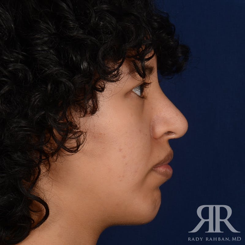 Chin Augmentation Before & After Gallery - Patient 328946 - Image 5