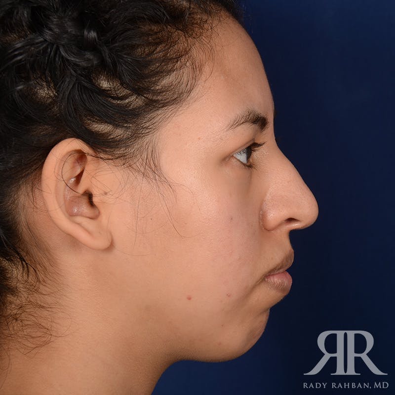 Chin Augmentation Before & After Gallery - Patient 328946 - Image 6