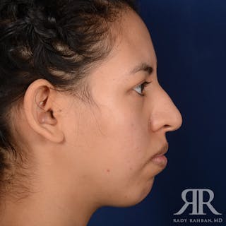 Chin Augmentation Before & After Gallery - Patient 328946 - Image 6