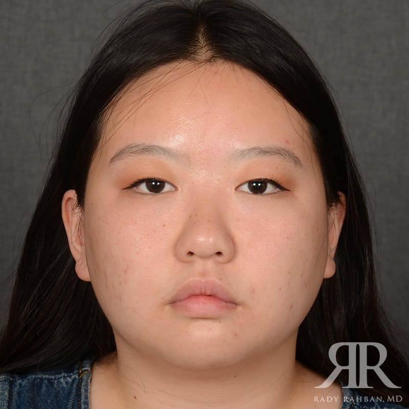 Chin Augmentation Before & After Gallery - Patient 415566 - Image 1