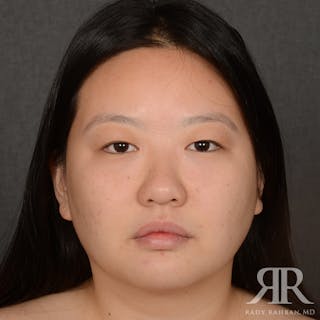 Chin Augmentation Before & After Gallery - Patient 415566 - Image 2
