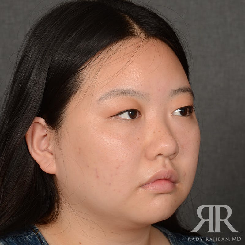 Chin Augmentation Before & After Gallery - Patient 415566 - Image 3