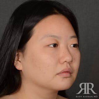 Chin Augmentation Before & After Gallery - Patient 415566 - Image 4