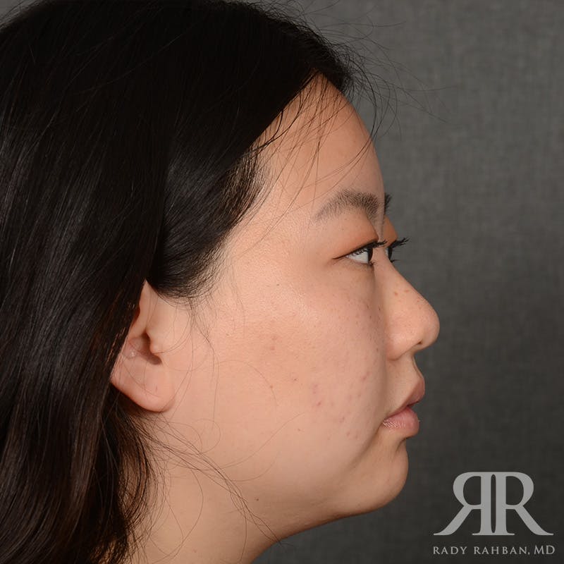 Chin Augmentation Before & After Gallery - Patient 415566 - Image 5