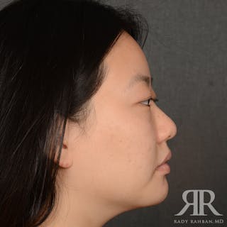 Chin Augmentation Before & After Gallery - Patient 415566 - Image 6