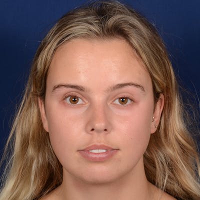 Female Rhinoplasty Before & After Gallery - Patient 110370 - Image 1