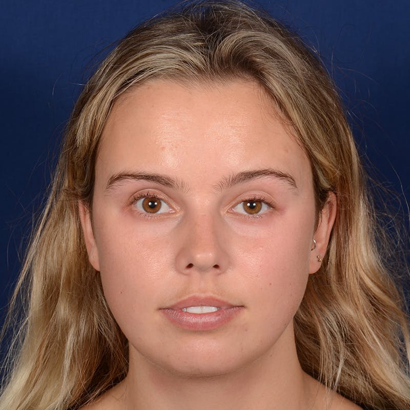 Female Rhinoplasty Before & After Gallery - Patient 110370 - Image 1