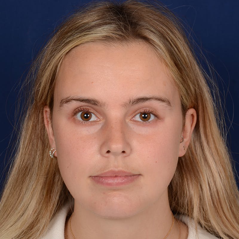 Female Rhinoplasty Before & After Gallery - Patient 110370 - Image 2