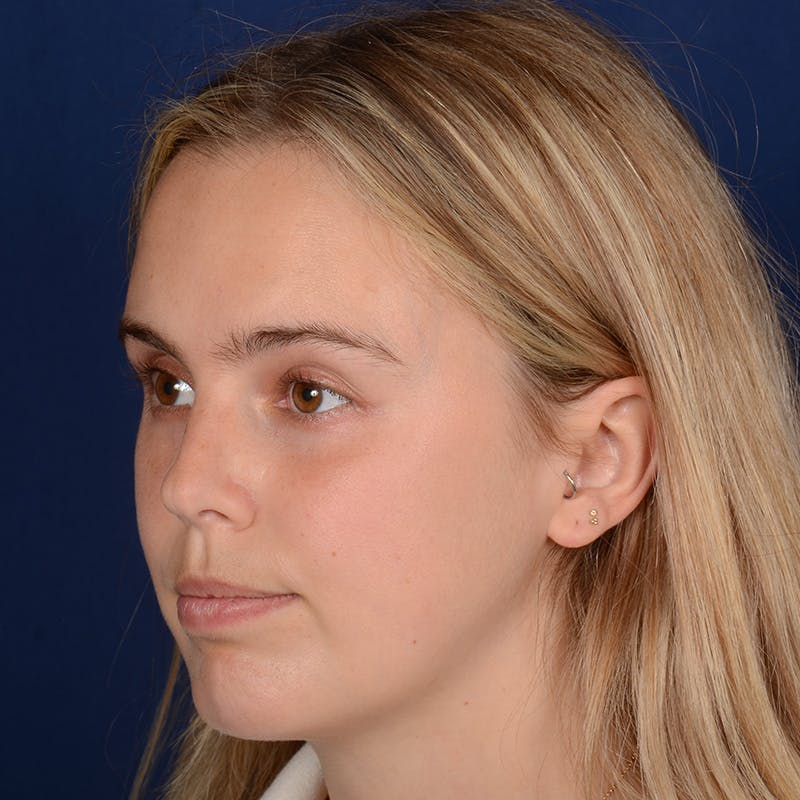 Female Rhinoplasty Before & After Gallery - Patient 110370 - Image 4