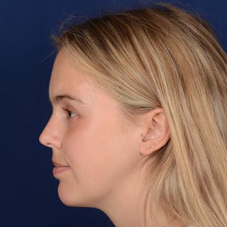 Female Rhinoplasty Before & After Gallery - Patient 110370 - Image 6