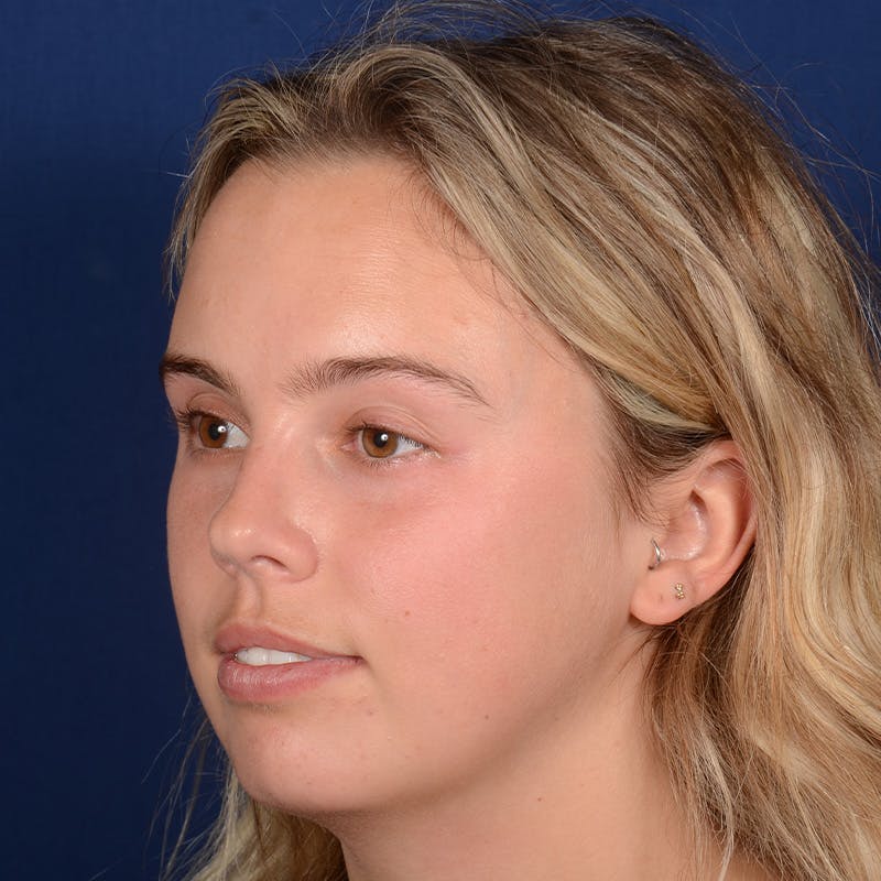 Female Rhinoplasty Before & After Gallery - Patient 110370 - Image 3