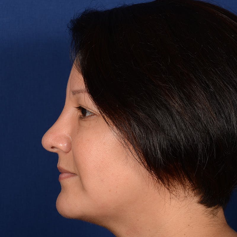 Female Rhinoplasty Before & After Gallery - Patient 255910 - Image 6