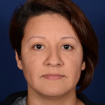 Female Rhinoplasty Before & After Gallery - Patient 255910 - Image 1