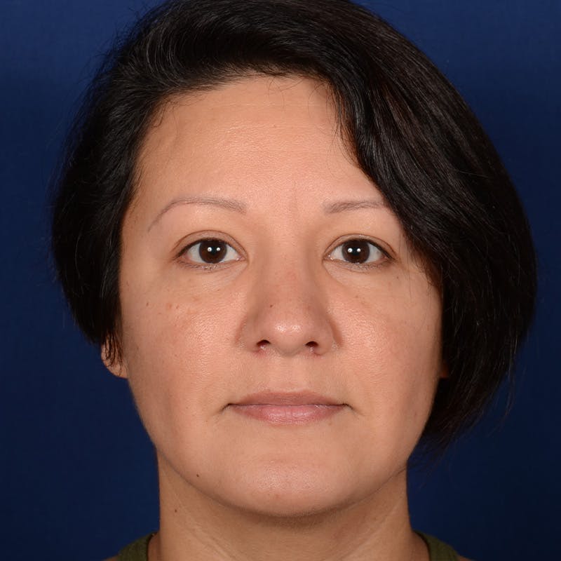 Female Rhinoplasty Before & After Gallery - Patient 255910 - Image 2