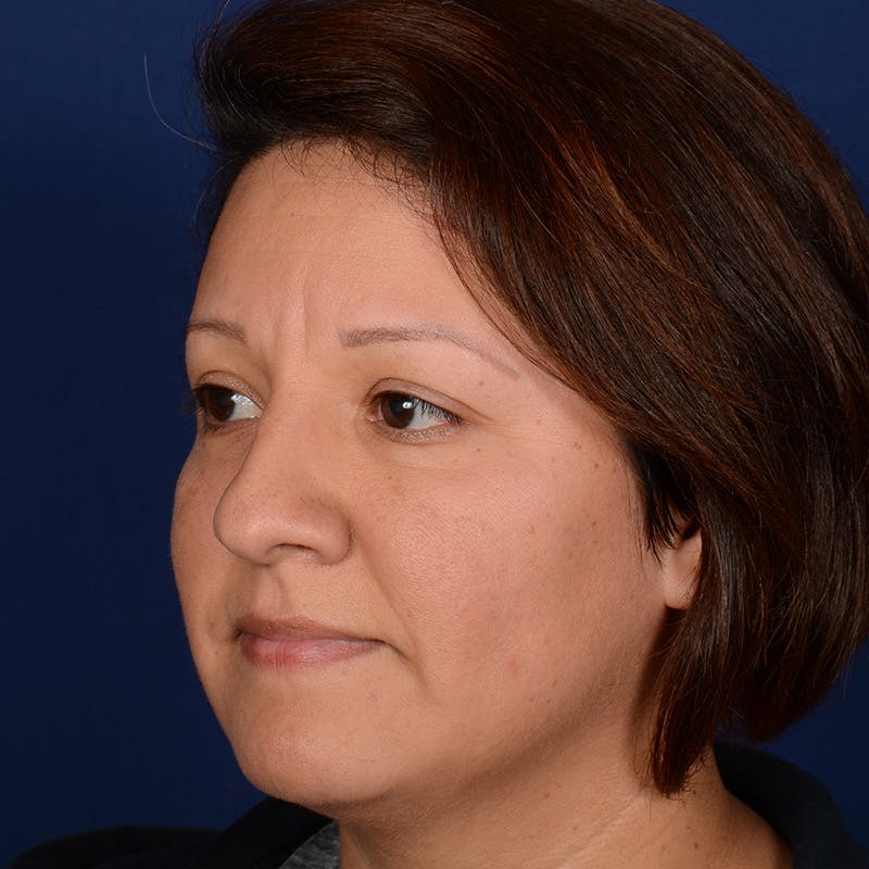 Female Rhinoplasty Before & After Gallery - Patient 255910 - Image 3