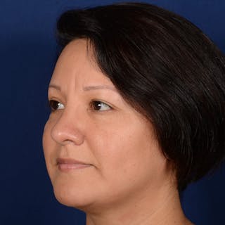 Female Rhinoplasty Before & After Gallery - Patient 255910 - Image 4