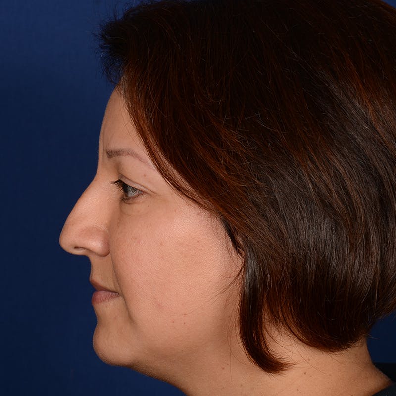 Female Rhinoplasty Before & After Gallery - Patient 255910 - Image 5