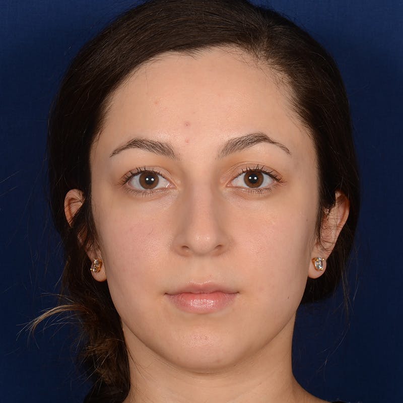 Female Rhinoplasty Before & After Gallery - Patient 121669 - Image 1