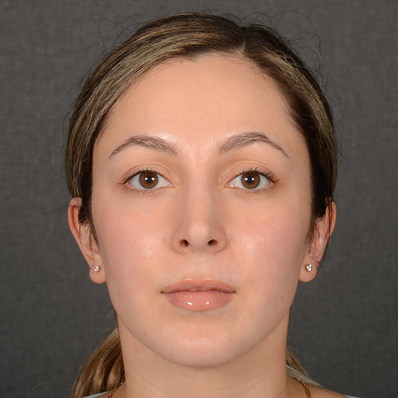 Female Rhinoplasty Before & After Gallery - Patient 121669 - Image 2