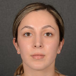 Female Rhinoplasty Before & After Gallery - Patient 121669 - Image 2