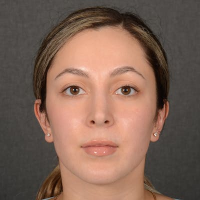 Female Rhinoplasty Before & After Gallery - Patient 121669 - Image 2
