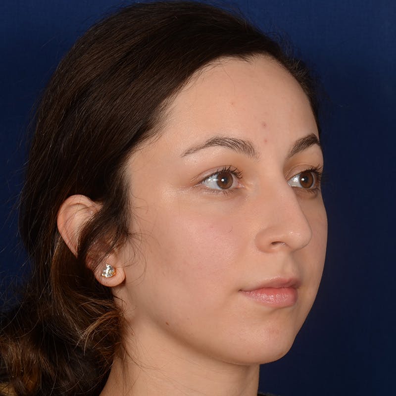 Female Rhinoplasty Before & After Gallery - Patient 121669 - Image 3