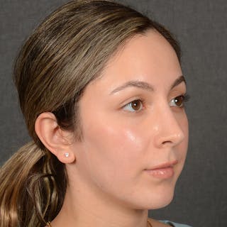 Female Rhinoplasty Before & After Gallery - Patient 121669 - Image 4