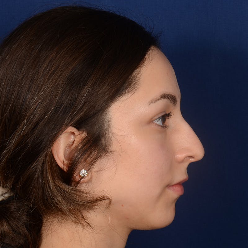 Female Rhinoplasty Before & After Gallery - Patient 121669 - Image 5