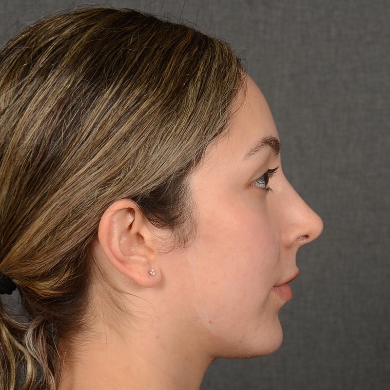 Female Rhinoplasty Before & After Gallery - Patient 121669 - Image 6