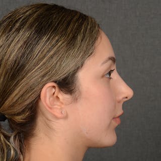 Female Rhinoplasty Before & After Gallery - Patient 121669 - Image 6