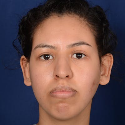 Female Rhinoplasty Before & After Gallery - Patient 122526 - Image 1