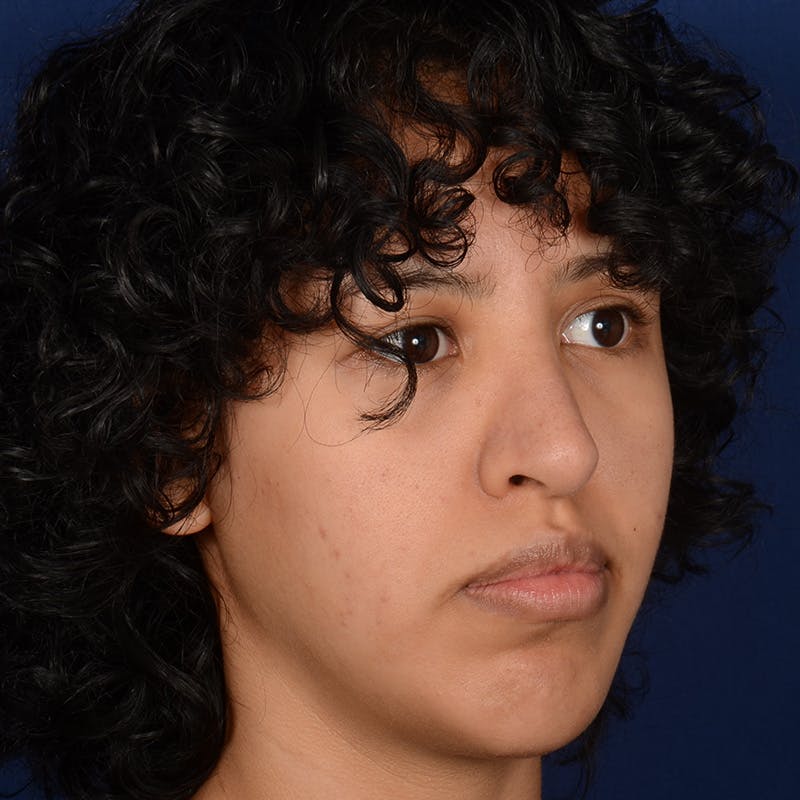 Female Rhinoplasty Before & After Gallery - Patient 122526 - Image 4