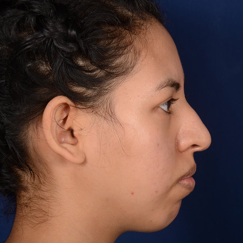 Female Rhinoplasty Before & After Gallery - Patient 122526 - Image 5