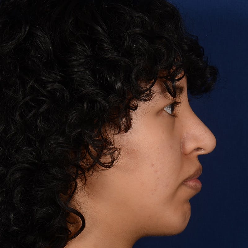 Female Rhinoplasty Before & After Gallery - Patient 122526 - Image 6