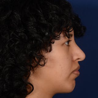 Female Rhinoplasty Before & After Gallery - Patient 122526 - Image 6