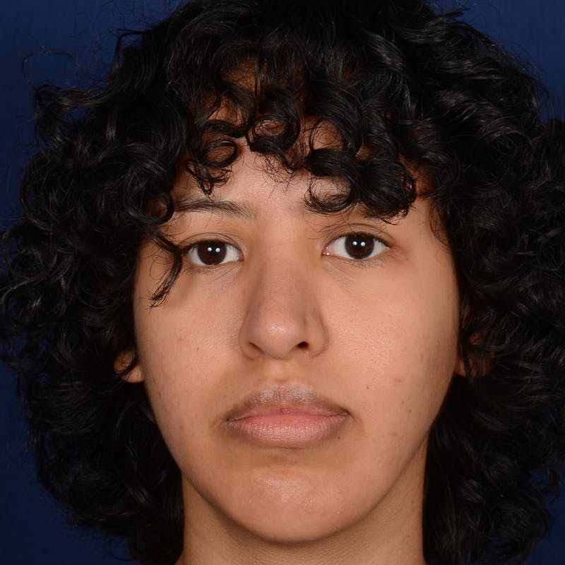 Female Rhinoplasty Before & After Gallery - Patient 122526 - Image 2