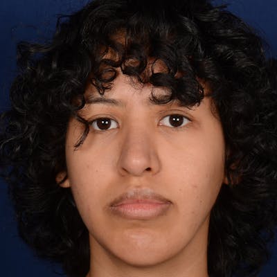 Female Rhinoplasty Before & After Gallery - Patient 122526 - Image 2