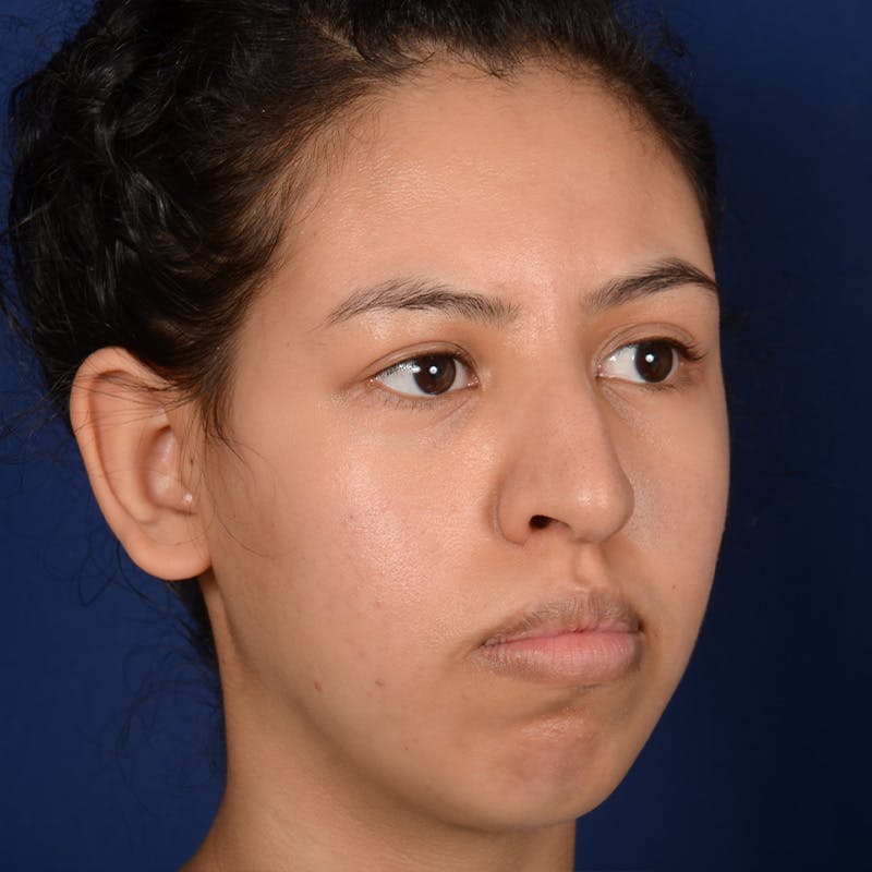 Female Rhinoplasty Before & After Gallery - Patient 122526 - Image 3